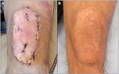 Assessment of Acute Rejection in a Lung Transplant Recipient Using a Sentinel Skin Flap